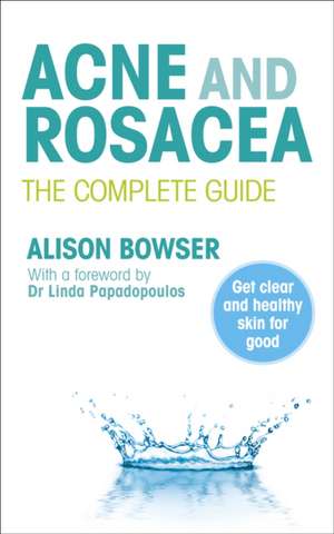 Acne and Rosacea de Alison Bowser