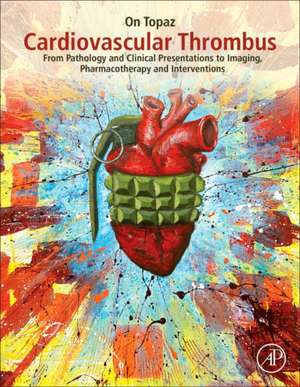 Cardiovascular Thrombus: From Pathology and Clinical Presentations to Imaging, Pharmacotherapy and Interventions de On Topaz