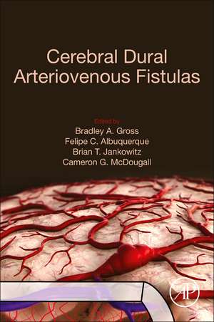 Cerebral Dural Arteriovenous Fistulas de Bradley A. Gross