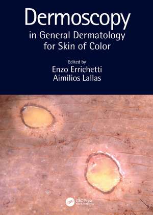 Dermoscopy in General Dermatology for Skin of Color de Enzo Errichetti