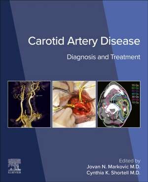 Carotid Artery Disease de Cynthia K. Shortell