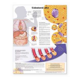 High Cholesterol Anatomical Chart in Spanish (Colesterol alto) de Anatomical Chart Company 