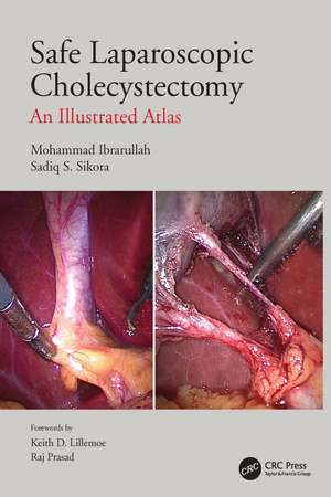 Safe Laparoscopic Cholecystectomy: An Illustrated Atlas de Mohammad Ibrarullah