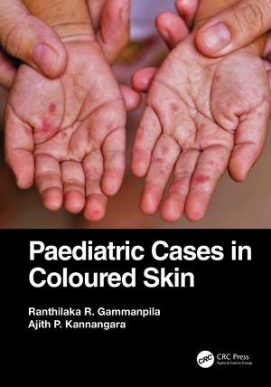 Paediatric Cases in Coloured Skin de Ranthilaka R. Gammanpila