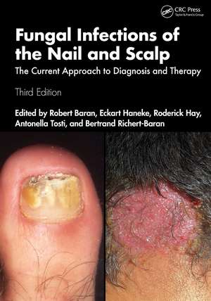 Fungal Infections of the Nail and Scalp: The Current Approach to Diagnosis and Therapy de Robert Baran