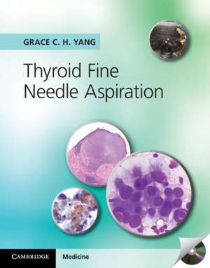 Thyroid Fine Needle Aspiration de Grace C. H. Yang