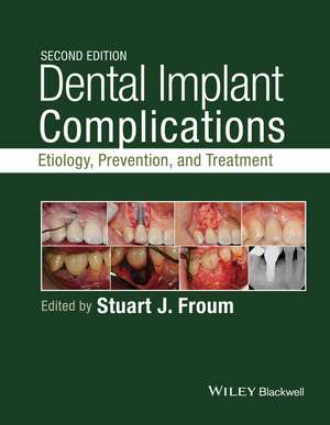 Dental Implant Complications – Etiology, , and Treatment, Second Edition de S Froum