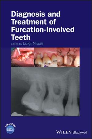 Diagnosis and Treatment of Furcation–Involved Teeth de L Nibali