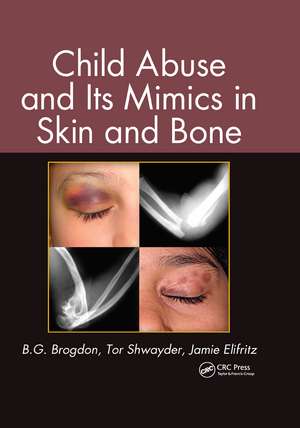 Child Abuse and its Mimics in Skin and Bone de B. G. Brogdon