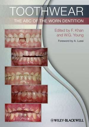 Toothwear – The ABC of the Worn Dentition de F Khan