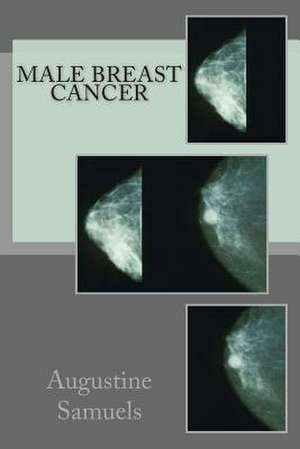 Male Breast Cancer de Augustine Samuels Ma