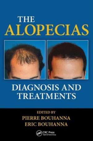 The Alopecias: Diagnosis and Treatments de Pierre Bouhanna