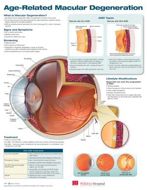 Age-Related Macular Degeneration Anatomical Chart de Anatomical Chart Company