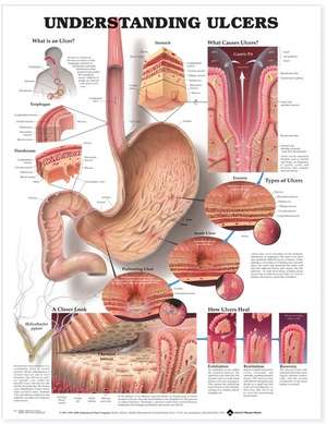 Understanding Ulcers Anatomical Chart de Anatomical Chart Company