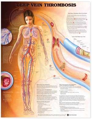 Deep Vein Thrombosis Anatomical Chart de Anatomical Chart Company