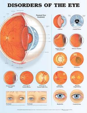 Disorders of the Eye Anatomical Chart de Anatomical Chart Company