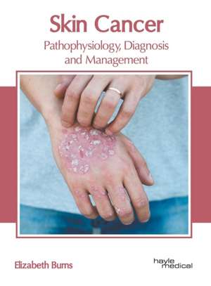 Skin Cancer: Pathophysiology, Diagnosis and Management de Elizabeth Burns