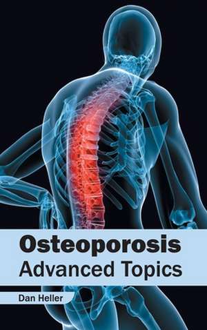 Osteoporosis de Dan Heller