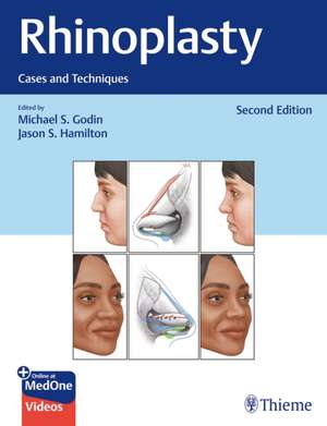 Rhinoplasty de Michael S. Godin