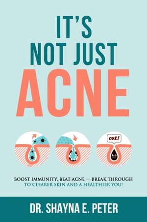 It's Not Just Acne de Shayna E Peter