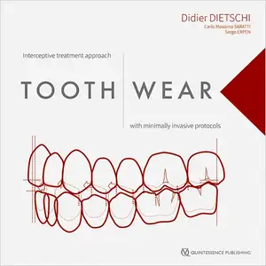 Tooth Wear: Interceptive treatment approach with minimally invasive protocols de Didier Dietschi