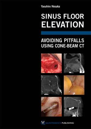 Sinus Floor Elevation: Avoiding Pitfalls Using Cone-Beam CT de Yasuhiro Nosaka