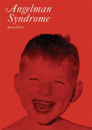 Angelman′s Syndrome de B Dan