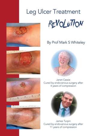 Leg Ulcer Treatment Revolution de Mark S Whiteley