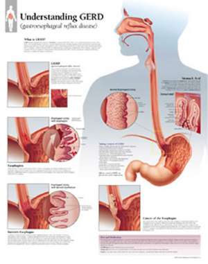 Understanding Gerd Chart: Wall Chart de Scientific Publishing