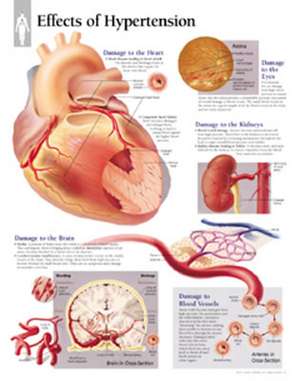 Effects of Hypertension Chart: Laminated Wall Chart de Scientific Publishing