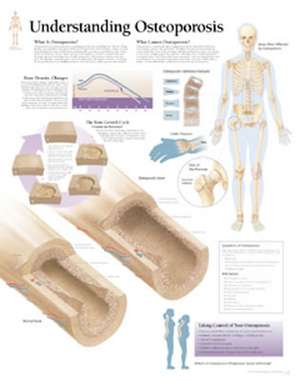 Understanding Osteoporosis Chart: Wall Chart de Scientific Publishing