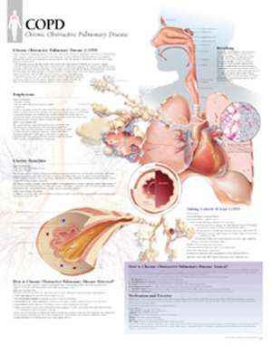 Copd Chart: Laminated Wall Chart: Laminated Wall Chart de Scientific Publishing