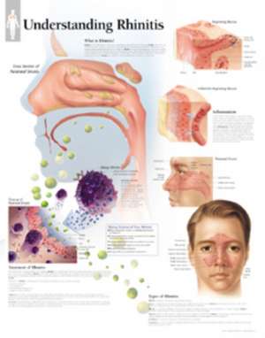 Understanding Rhinitis Chart: Wall Chart de Scientific Publishing