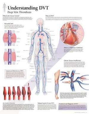 Understanding Dvt Chart: Laminated Wall Chart de various