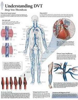 Understanding DVT Laminated Poster de Scientific Publishing