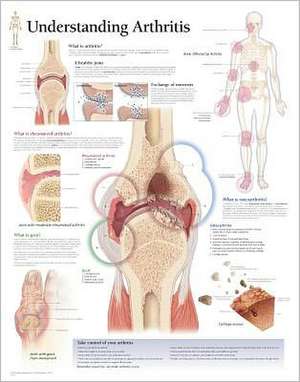 Understanding Arthritis Chart: Laminated Wall Chart de various