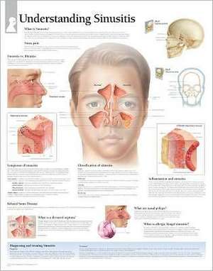 Understanding Sinusitis Chart: Wall Chart de various