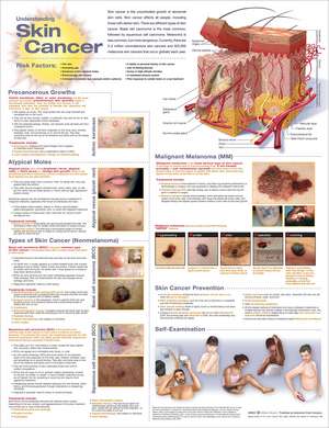 Understanding Skin Cancer Anatomical Chart de Anatomical Chart Company