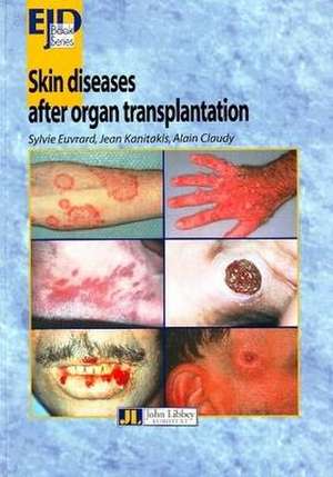 Skin Diseases After Organ Transplantation de Sylvie Euvrard