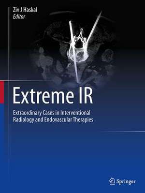 Extreme IR: Extraordinary Cases in Interventional Radiology and Endovascular Therapies de Ziv J Haskal