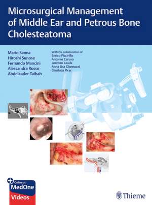 Microsurgical Management of Middle Ear and Petrous Bone Cholesteatoma de Mario Sanna