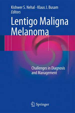 Lentigo Maligna Melanoma: Challenges in Diagnosis and Management de Kishwer S. Nehal