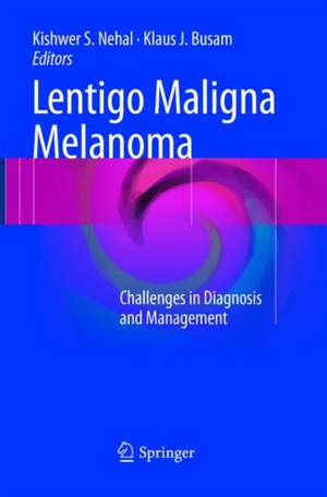 Lentigo Maligna Melanoma: Challenges in Diagnosis and Management de Kishwer S. Nehal