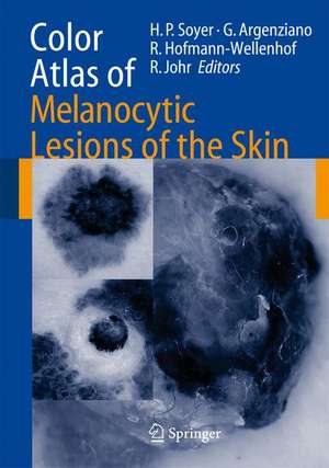 Color Atlas of Melanocytic Lesions of the Skin de H. Peter Soyer