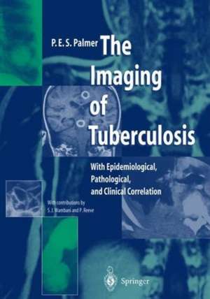 The Imaging of Tuberculosis: With Epidemiological, Pathological, and Clinical Correlation de P.E.S. Palmer