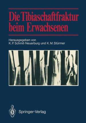 Die Tibiaschaftfraktur beim Erwachsenen: Symposium anläßlich des 10jährigen Bestehens der Abteilung für Unfallchirurgie am Klinikum Essen, 1./2. Februar 1985 in Essen de K. P. Schmit-Neuerburg