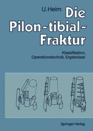 Die Pilon-tibial-Fraktur: Klassifikation, Operationstechnik, Ergebnisse de M. Allgöwer