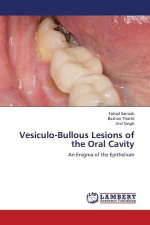 Vesiculo-Bullous Lesions of the Oral Cavity de Samadi Fahad