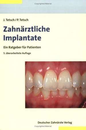 Zahnärztliche Implantate de Jan Tetsch