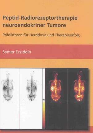 Peptid-Radiorezeptortherapie neuroendokriner Tumore de Samer Ezziddin